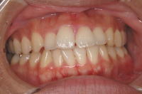 歯列矯正2