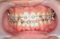 歯列矯正3