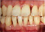 歯周病治療4