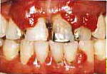 歯周病治療6