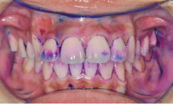 予防歯科9